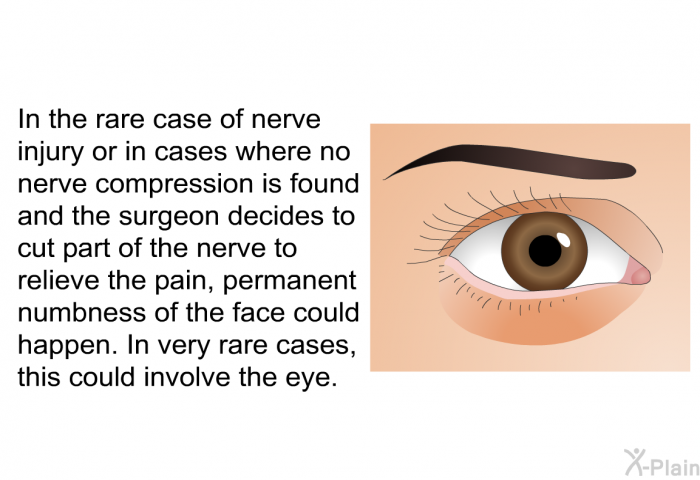 In the rare case of nerve injury or in cases where no nerve compression is found and the surgeon decides to cut part of the nerve to relieve the pain, permanent numbness of the face could happen. In very rare cases, this could involve the eye.