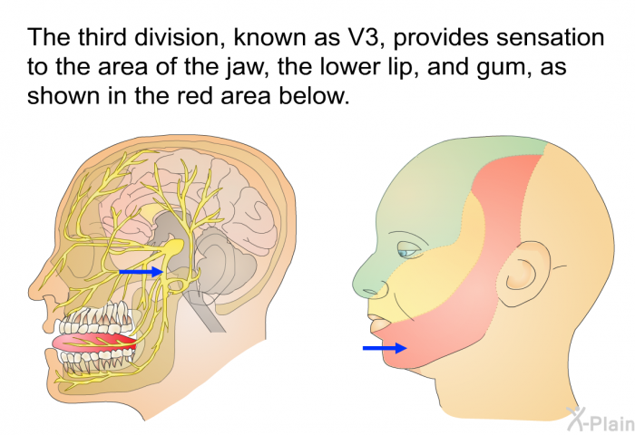 The third division, known as V3, provides sensation to the area of the jaw, the lower lip, and gum, as shown in the red area below.