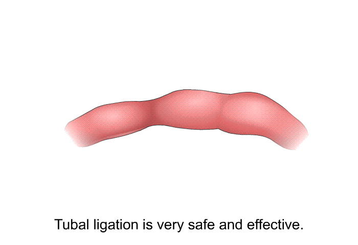 Tubal ligation is very safe and effective.