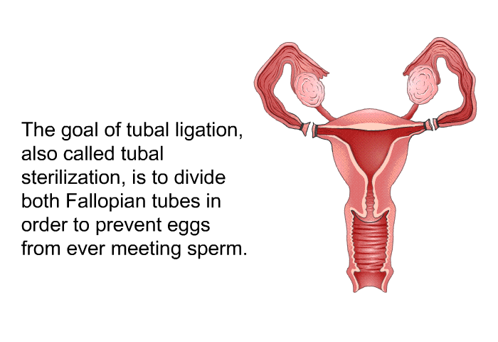 The goal of tubal ligation, also called tubal sterilization, is to divide both Fallopian tubes in order to prevent eggs from ever meeting sperm.