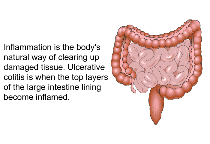 Inflammation is the body's natural way of clearing up damaged tissue. Ulcerative colitis is when the top layers of the large intestine lining become inflamed.