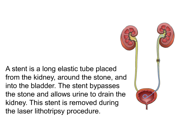 A stent is a long elastic tube placed from the kidney, around the stone, and into the bladder. The stent bypasses the stone and allows urine to drain the kidney. This stent is removed during the laser lithotripsy procedure.