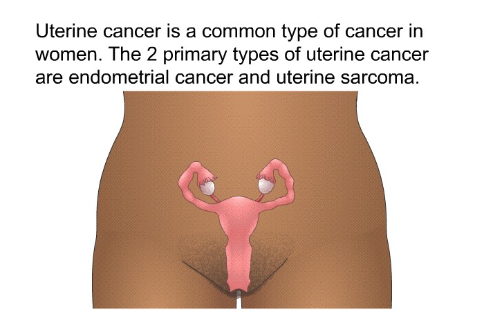 Uterine cancer is a common type of cancer in women. The 2 primary types of uterine cancer are endometrial cancer and uterine sarcoma.