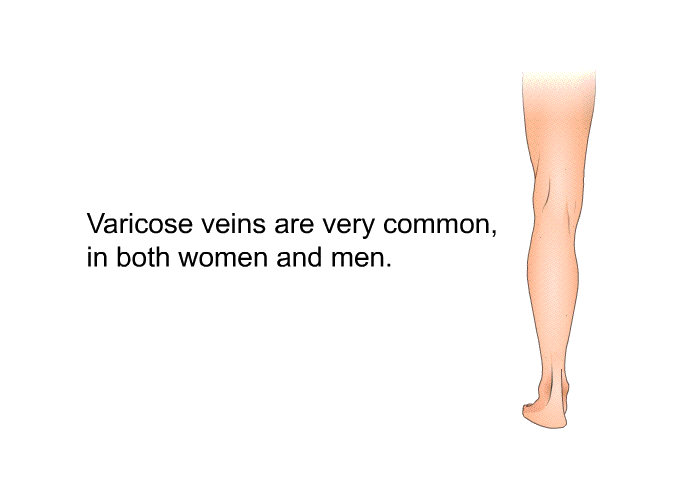 Varicose veins are very common, in both women and men.