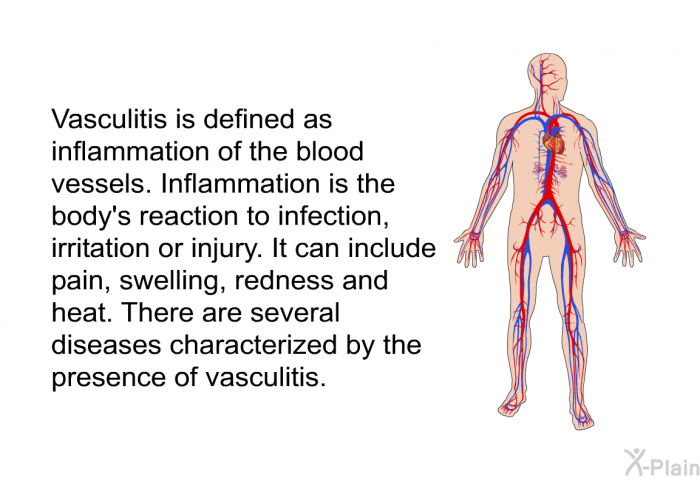 Vasculitis is defined as inflammation of the blood vessels. Inflammation is the body's reaction to infection, irritation or injury. It can include pain, swelling, redness and heat. There are several diseases characterized by the presence of vasculitis.