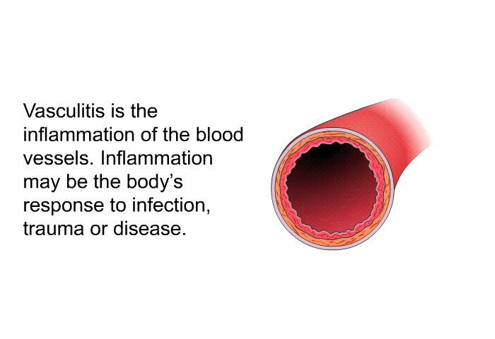 Vasculitis is the inflammation of the blood vessels. Inflammation may be the body's response to infection, trauma or disease.