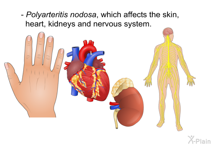 Polyarteritis nodosa, which affects the skin, heart, kidneys and nervous system.