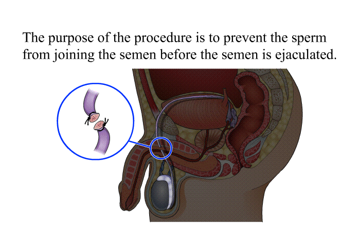 The purpose of the procedure is to prevent the sperm from joining the semen before the semen is ejaculated.