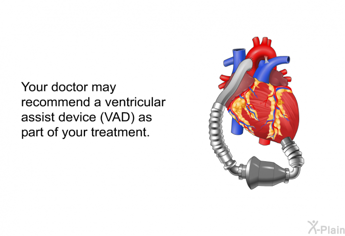 Your doctor may recommend a ventricular assist device (VAD) as part of your treatment.