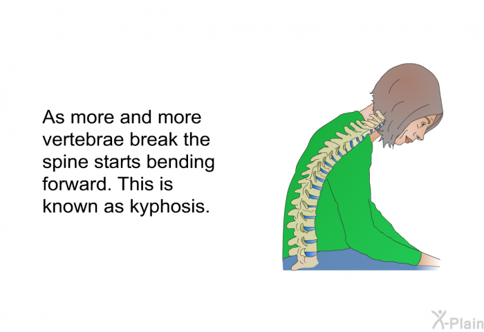 As more and more vertebrae break the spine starts bending forward. This is known as kyphosis.