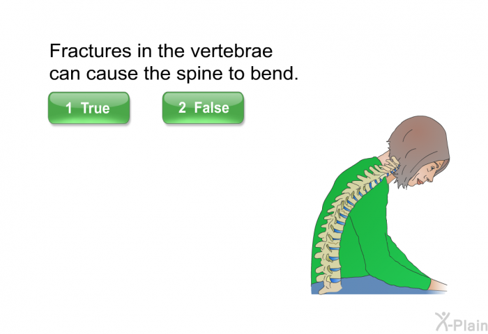 Fractures in the vertebrae can cause the spine to bend. Press True or False