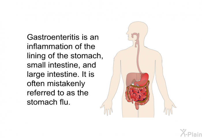 Gastroenteritis is an inflammation of the lining of the stomach, small intestine, and large intestine. It is often mistakenly referred to as the stomach flu.