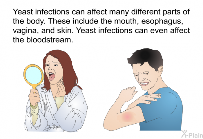 Yeast infections can affect many different parts of the body. These include the mouth, esophagus, vagina, and skin. Yeast infections can even affect the bloodstream.