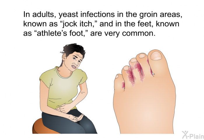 In adults, yeast infections in the groin areas, known as “jock itch,” and in the feet, known as “athlete's foot,” are very common.