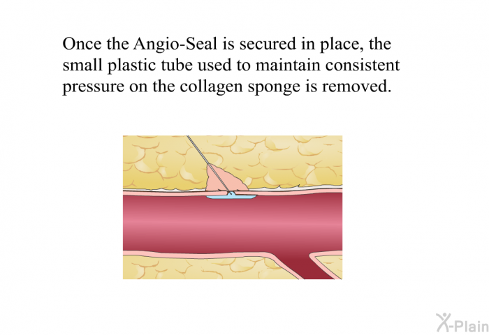 Once the Angio-Seal is secured in place, the small plastic tube used to maintain consistent pressure on the collagen sponge is removed.
