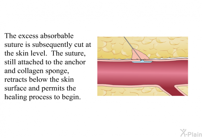 The excess absorbable suture is subsequently cut at the skin level. The suture, still attached to the anchor and collagen sponge, retracts below the skin surface and permits the healing process to begin.