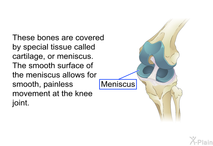 These bones are covered by special tissue called cartilage, or meniscus. The smooth surface of the meniscus allows for smooth, painless movement at the knee joint.