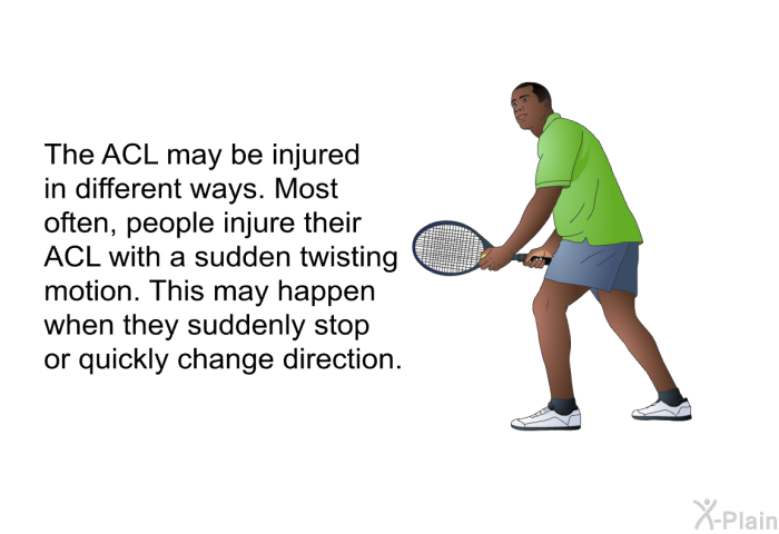 The ACL may be injured in different ways. Most often, people injure their ACL with a sudden twisting motion. This may happen when they suddenly stop or quickly change direction.