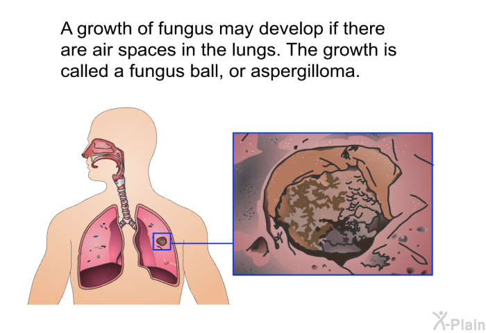 A growth of fungus may develop if there are air spaces in the lungs. The growth is called a fungus ball, or aspergilloma.