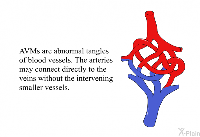 AVMs are abnormal tangles of blood vessels. The arteries may connect directly to the veins without the intervening smaller vessels.