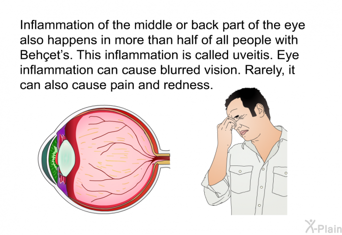 Inflammation of the middle or back part of the eye also happens in more than half of all people with Behçet's. This inflammation is called uveitis. Eye inflammation can cause blurred vision. Rarely, it can also cause pain and redness.