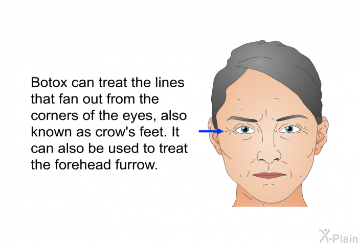 Botox can treat the lines that fan out from the corners of the eyes, also known as crow's feet. It can also be used to treat the forehead furrow.