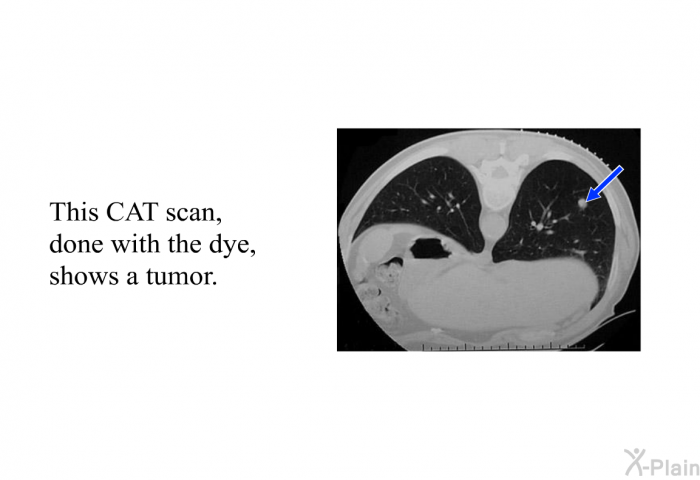 This CAT scan, done with the dye, shows a tumor.