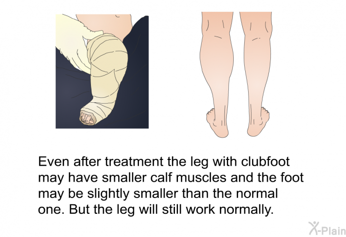 Even after treatment the leg with clubfoot may have smaller calf muscles and the foot may be slightly smaller than the normal one. But the leg will still work normally.