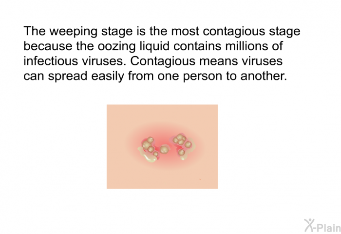 The weeping stage is the most contagious stage because the oozing liquid contains millions of infectious viruses. Contagious means viruses can spread easily from one person to another.