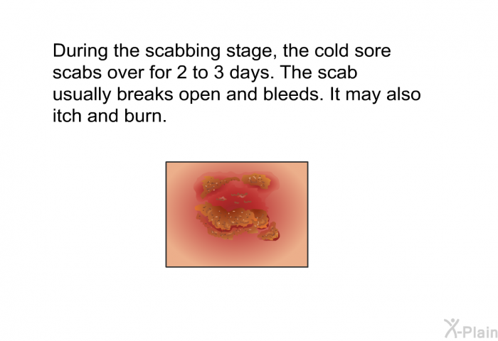 During the scabbing stage, the cold sore scabs over for 2 to 3 days. The scab usually breaks open and bleeds. It may also itch and burn.