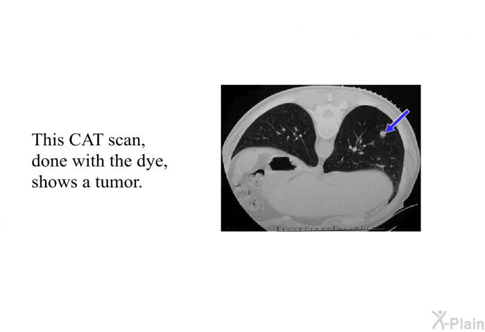 This CAT scan, done with the dye, shows a tumor.