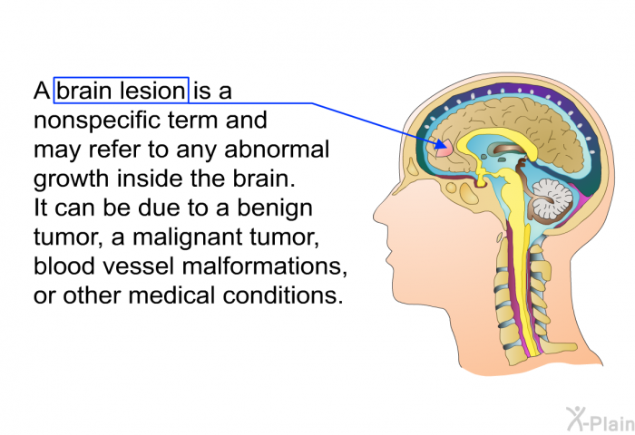 A brain lesion is a nonspecific term and may refer to any abnormal growth inside the brain. It can be due to a benign tumor, a malignant tumor, blood vessel malformations, or other medical conditions.