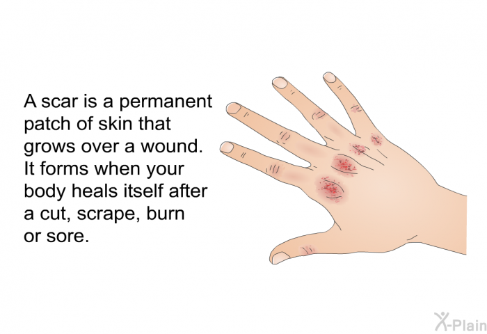 A scar is a permanent patch of skin that grows over a wound. It forms when your body heals itself after a cut, scrape, burn or sore.