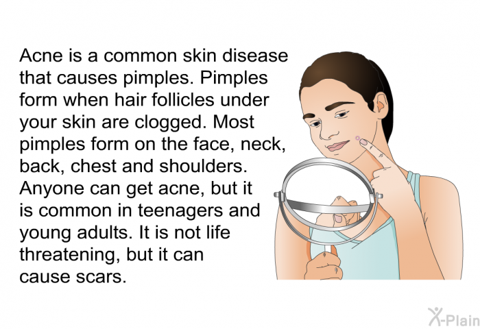 Acne is a common skin disease that causes pimples. Pimples form when hair follicles under your skin are clogged. Most pimples form on the face, neck, back, chest and shoulders. Anyone can get acne, but it is common in teenagers and young adults. It is not life threatening, but it can cause scars.