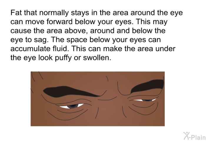 Fat that normally stays in the area around the eye can move forward below your eyes. This may cause the area above, around and below the eye to sag. The space below your eyes can accumulate fluid. This can make the area under the eye look puffy or swollen.