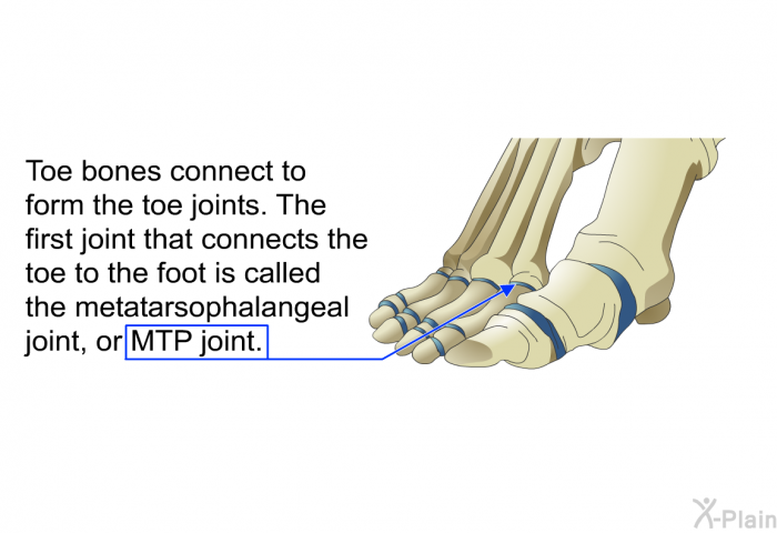 Toe bones connect to form the toe joints. The first joint that connects the toe to the foot is called the metatarsophalangeal joint, or MTP joint.