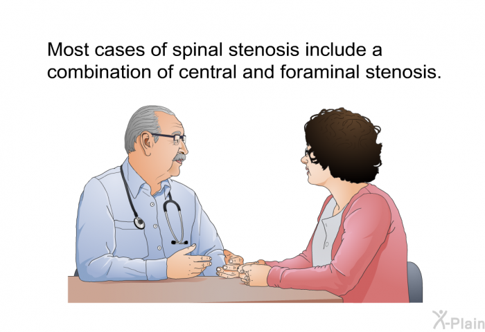 Most cases of spinal stenosis include a combination of central and foraminal stenosis.