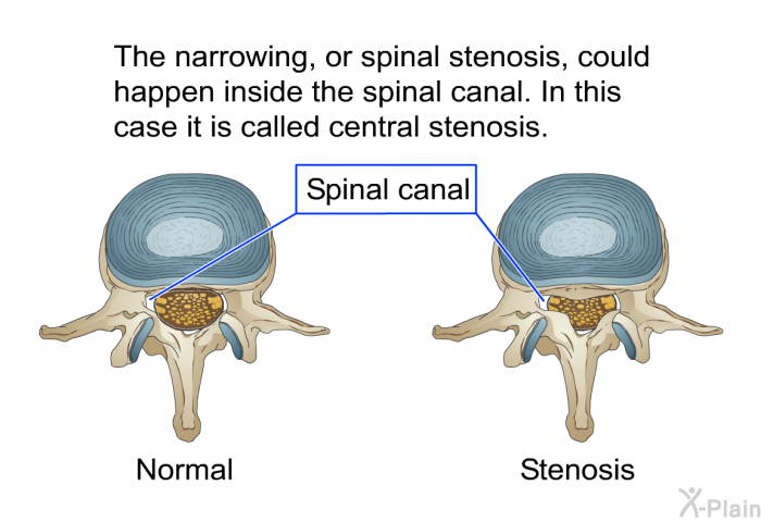 The narrowing, or spinal stenosis, could happen inside the spinal canal. In this case it is called central stenosis.