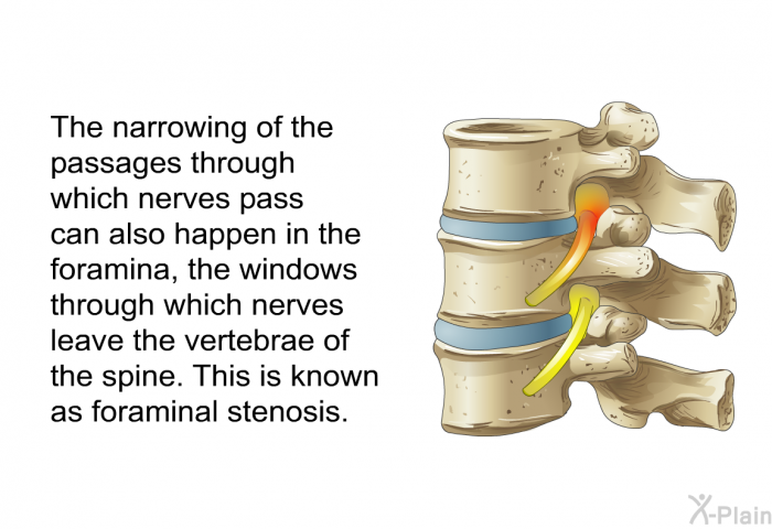 The narrowing of the passages through which nerves pass can also happen in the foramina, the windows through which nerves leave the vertebrae of the spine. This is known as foraminal stenosis.