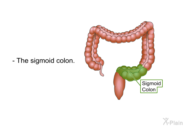 The sigmoid colon.