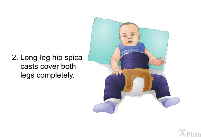 Long-leg hip spica casts cover both legs completely.