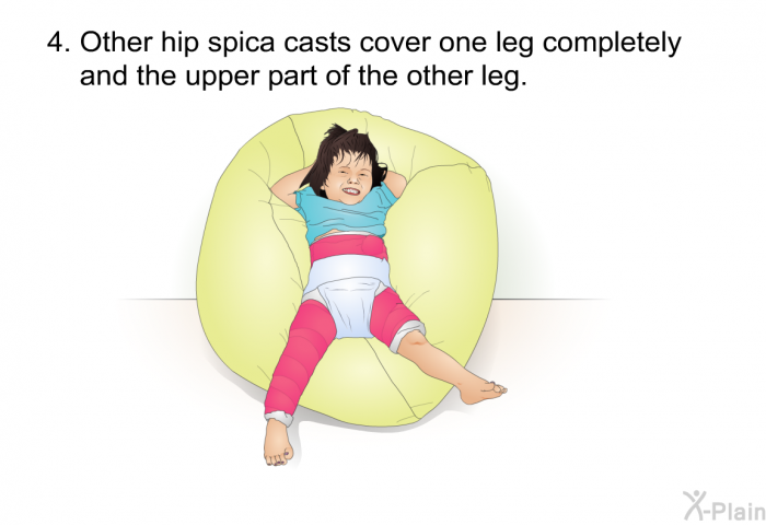 Other hip spica casts cover one leg completely and the upper part of the other leg.