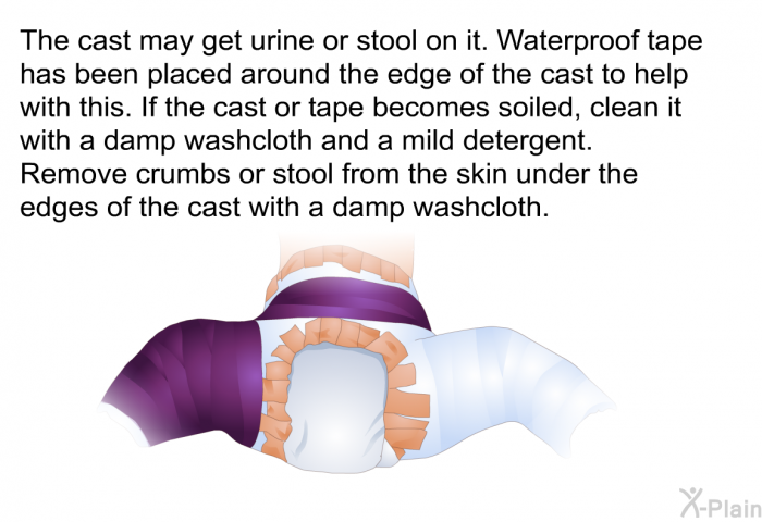 The cast may get urine or stool on it. Waterproof tape has been placed around the edge of the cast to help with this. If the cast or tape becomes soiled, clean it with a damp washcloth and a mild detergent. Remove crumbs or stool from the skin under the edges of the cast with a damp washcloth.