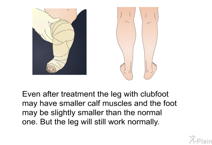 Even after treatment the leg with clubfoot may have smaller calf muscles and the foot may be slightly smaller than the normal one. But the leg will still work normally.