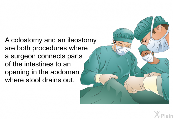 A colostomy and an ileostomy are both procedures where a surgeon connects parts of the intestines to an opening in the abdomen where stool drains out.