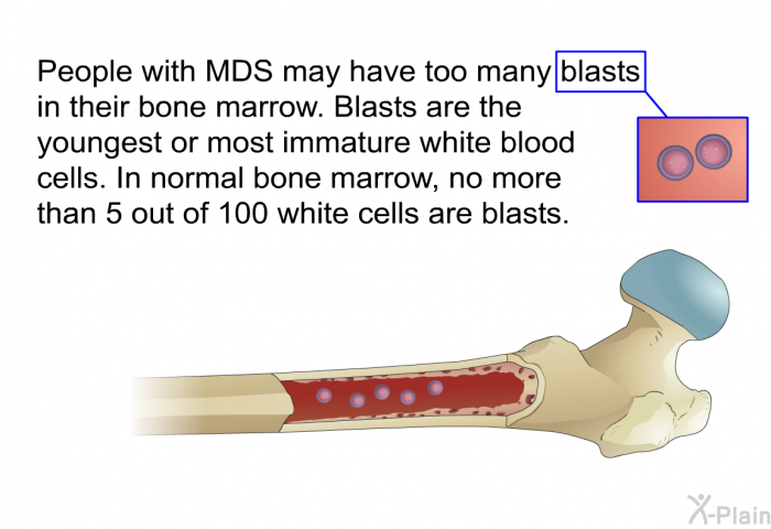 People with MDS may have too many blasts in their bone marrow. Blasts are the youngest or most immature white blood cells. In normal bone marrow, no more than 5 out of 100 white cells are blasts.