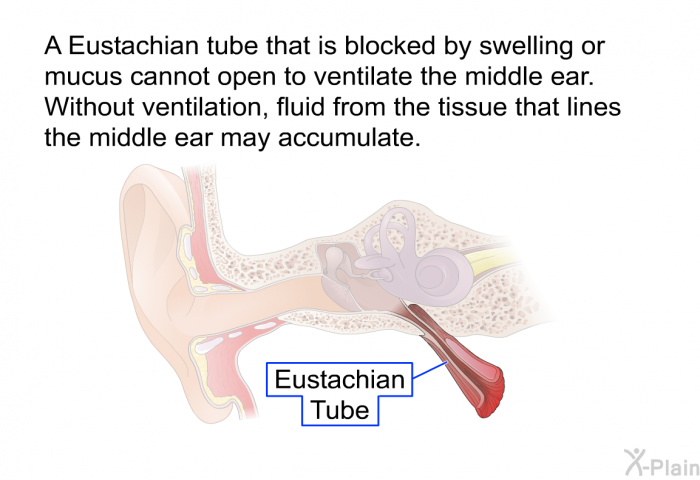 A Eustachian tube that is blocked by swelling or mucus cannot open to ventilate the middle ear. Without ventilation, fluid from the tissue that lines the middle ear may accumulate.