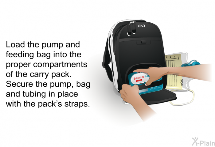 Load the pump and feeding bag into the proper compartments of the carry pack. Secure the pump, bag and tubing in place with the pack's straps.