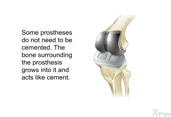 Some prostheses do not need to be cemented. The bone surrounding the prosthesis grows into it and acts like cement.