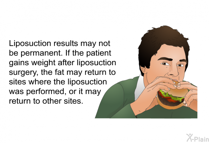 Liposuction results may not be permanent. If the patient gains weight after liposuction surgery, the fat may return to sites where the liposuction was performed, or it may return to other sites.